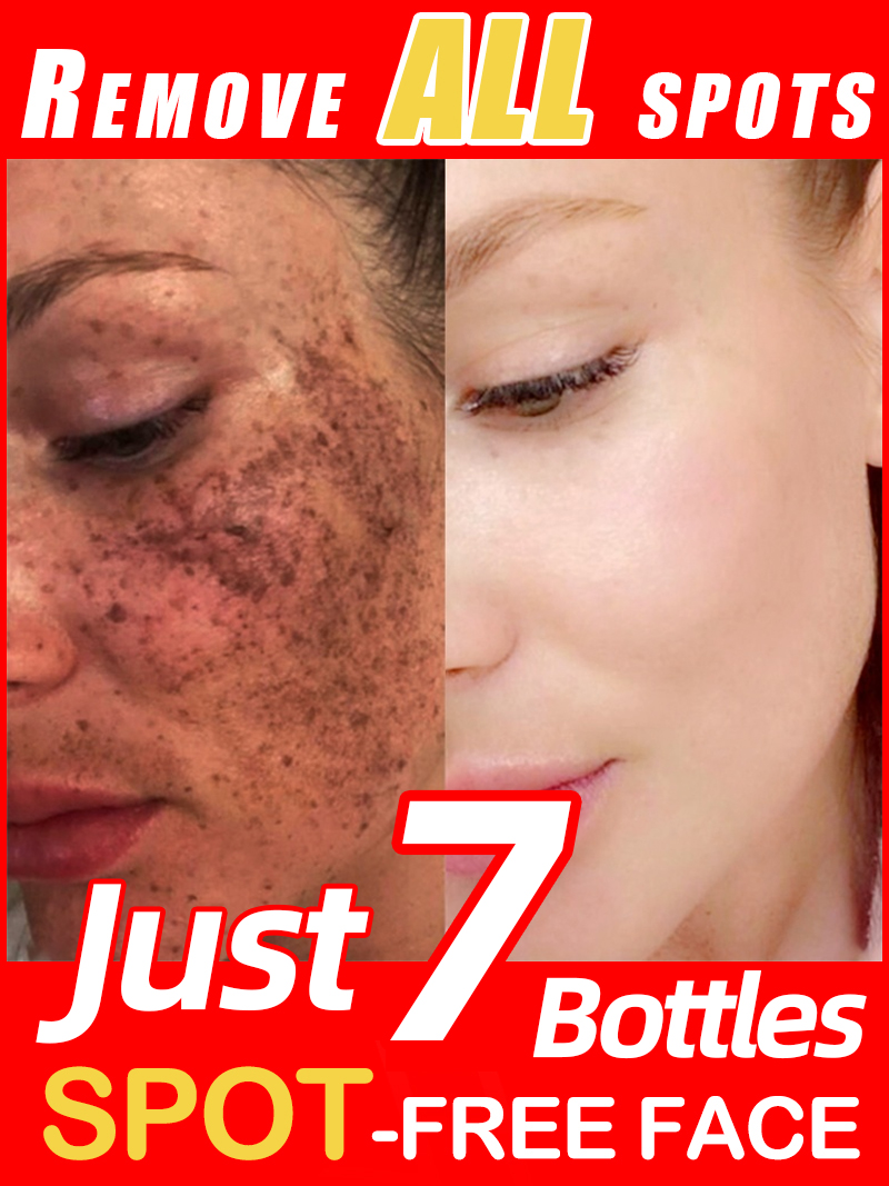 Lighten Freckles Melasma, Faci - Ultra Luxury Skincare ulasan dan harga